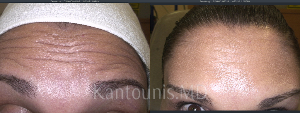 BOTOX