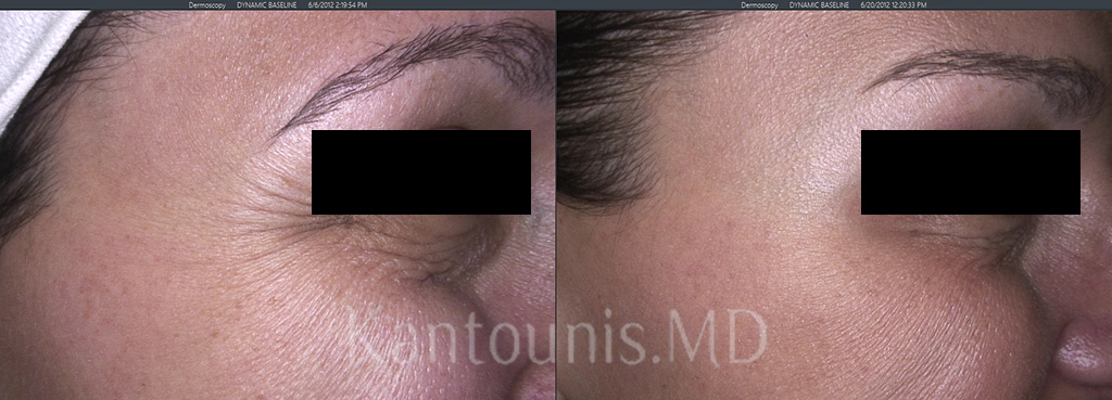 BOTOX
